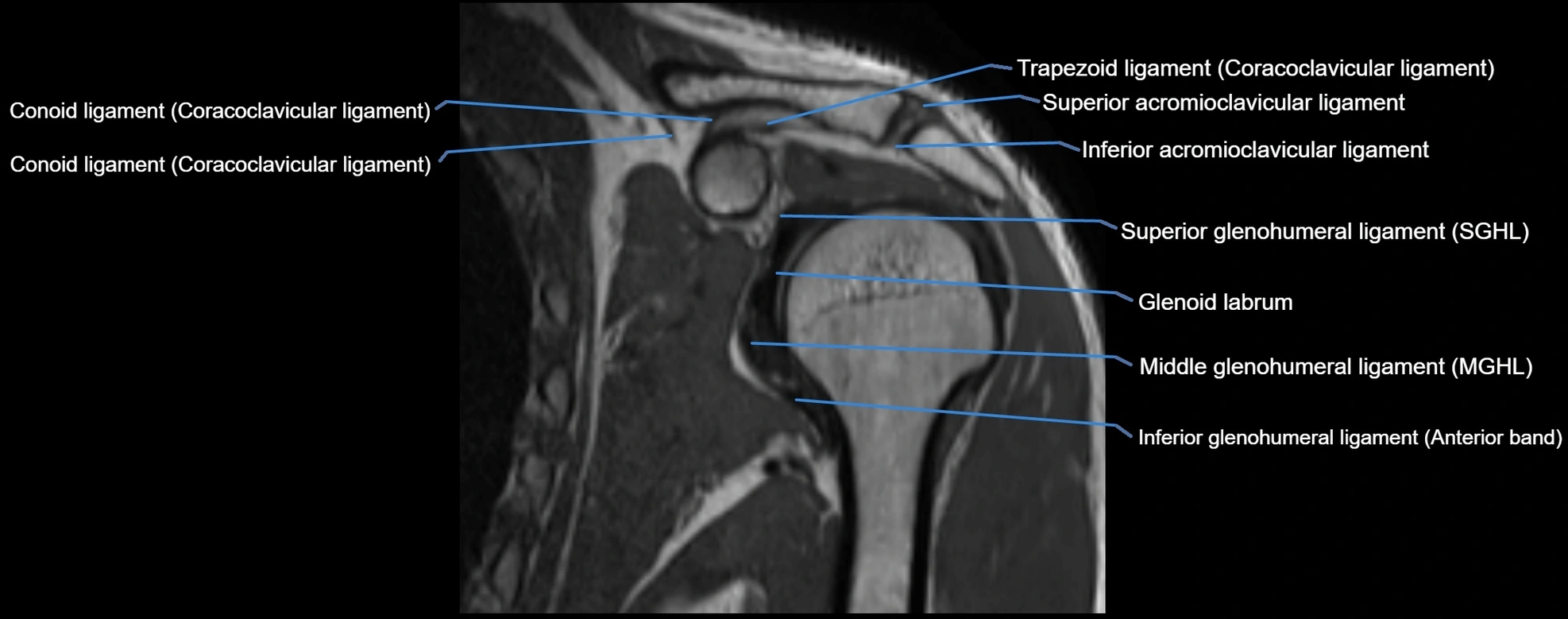 shoulder ligments coronal  cross sectional anatomy 3T MRI AI enhanced radiology image -img-00001-00023.webp